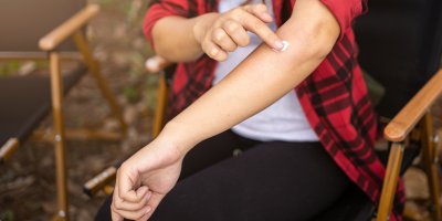 Člověk si maže štípanec na paži léčivým přípravkem