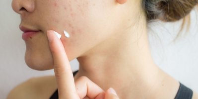Péči o pleť trpící akné musíme volit opatrně.