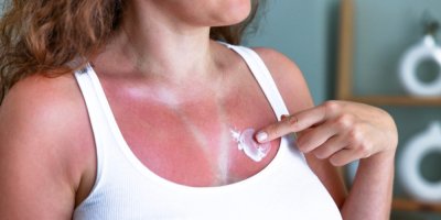 Žena se spáleným dekoltem si aplikuje krém