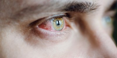 Detailní záběr na zarudlé oko muže