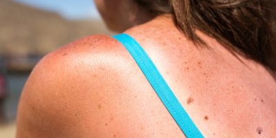 Spálená pokožka ženy po opalování