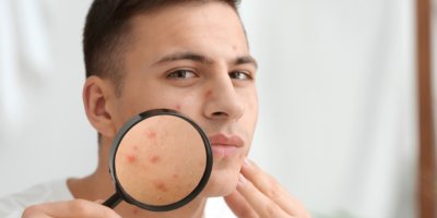 Muž si lupou přibližuje akné na tváři