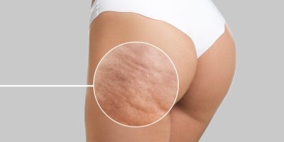 Ženská postava zezadu, detail na celulitidu na hýždích