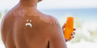 Muž má na spálených zádech krémem namalovaný smutný obličej, v ruce drží krém