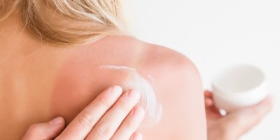 Žena si maže spálená záda