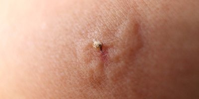 Detail včelího bodnutí