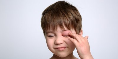 Malý chlapec s oteklým okem