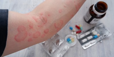 Ruka s alergickou reakcí