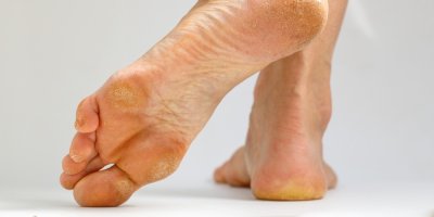 Chodidla ze spodní strany, suchá kůže