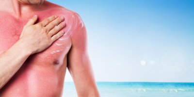 Muž si natírá spálenou hruď