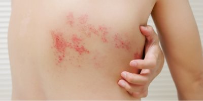 Vyrážka na zádech