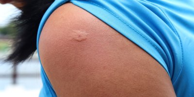 Oteklé místo na paži, kde ženu štípnul hmyz.