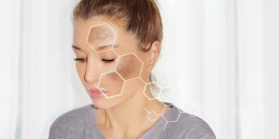 Žena, na jejímž obličeji jsou graficky vyznačena místa s pigmentovými skvrnami