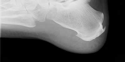 Rentgen patní ostruhy