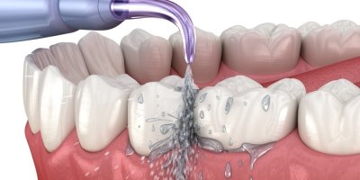 Ilustrace čištění zubů ústní sprchou