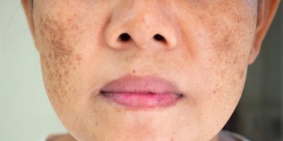 Obličej ženy s pigmentovými skvrnami na tvářích