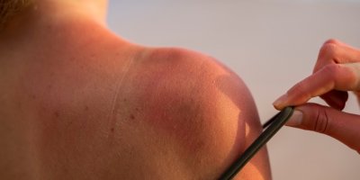 Pokožka spálená sluncem