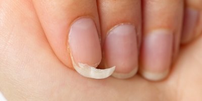 Detail prstu s ulomeným nehtem