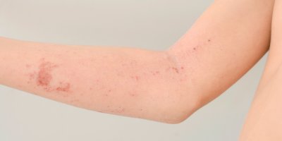 Paže dítěte s dermatitidou