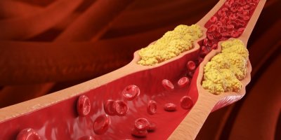 Ilustrace vysoké hladiny cholesterolu v krvi