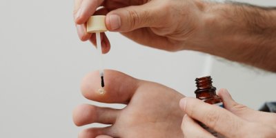 Muž si nanáší tekutinu na bradavici na noze