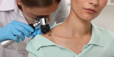 Dermatolog vyšetřuje pigmentové znaménko dermatoskopem 