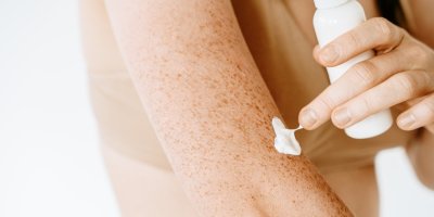Nanášení opalovacího krému na pokožku s pigmentovými skvrnami 