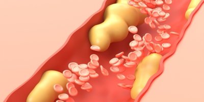 Cholesterol na vnitřních stěnách tepny