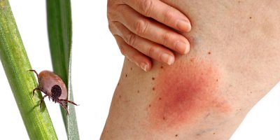 Nepodceňujte nestandardní chování těla, pokud jste měli klíště