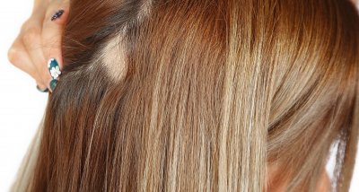 Jedním z prvních znaků trakční alopecie je rozšiřující se pěšinka ve vlasech.