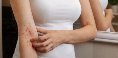 Žena si škrábe vyrážku na ruce