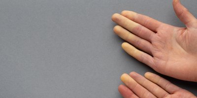 Proč vám v zimě bělají prsty? Může jít o Raynaudův fenomén, který postihuje hlavně ženy