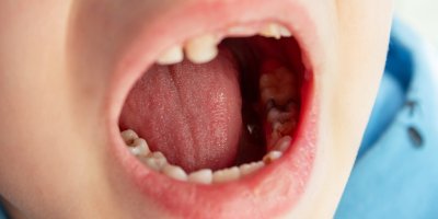 Jak zabránit dětským kazům po sladkém pití? Rizikové jsou i 100% džusy, nejhorší je zlozvyk dětí, říkají stomatologové