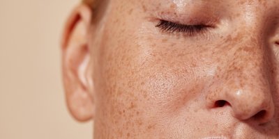Hyperpigmentace se v létě rychle zhoršuje. Dermatoložka radí, jak chránit pigmentové skvrny
