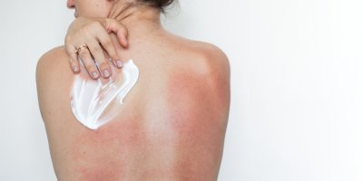 After sun přípravky po spálení: Panthenol a aloe vera pomohou zklidnit kůži, zázrak ale nečekejte