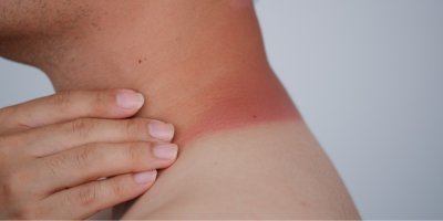 Bílý jogurt ani tvaroh spáleniny od slunce nezahojí. Lékařka vysvětluje realitu známé babské rady